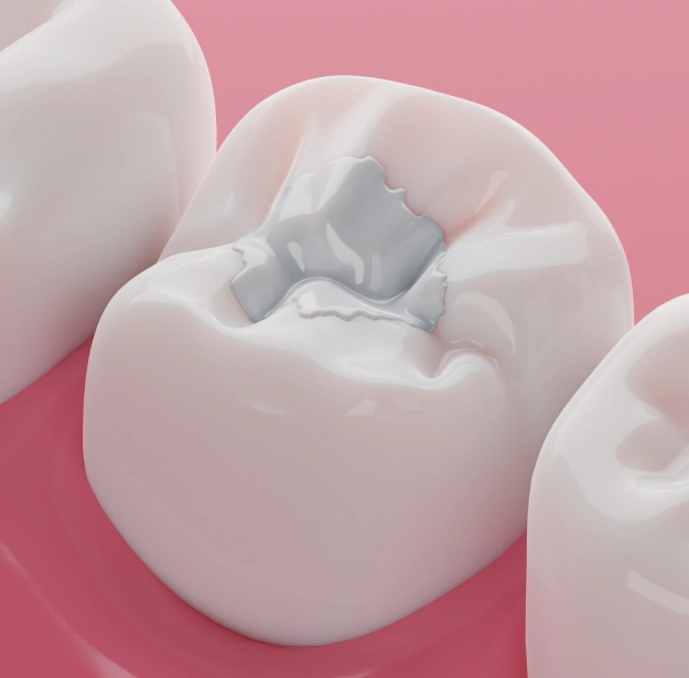 Fillings